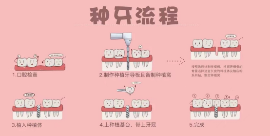 凯时k8官网下载牙齿修复牙齿种植步骤和流程种植牙价格更“亲民”但这些流程必知晓！